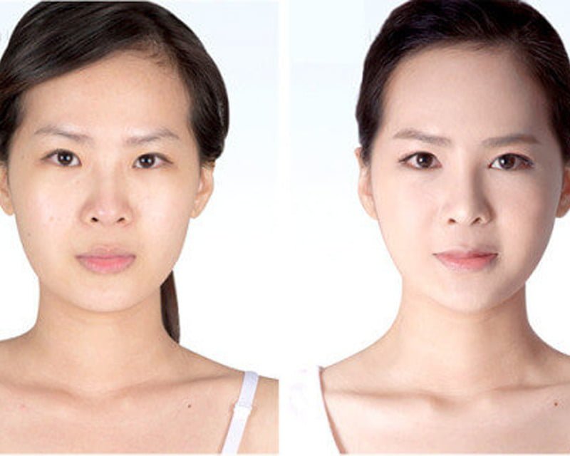 Cấy mỡ mặt an toàn (Nguồn: Internet)