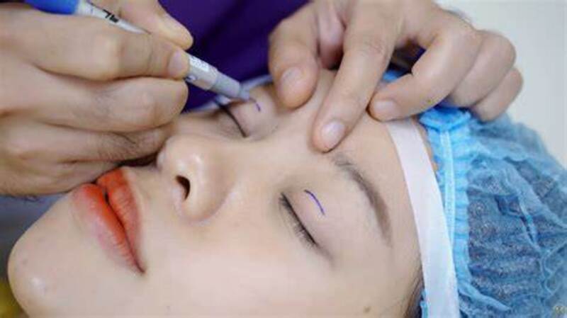 Bác sĩ Điền chuẩn bị thực hiện cắt mí (Nguồn:Internet)