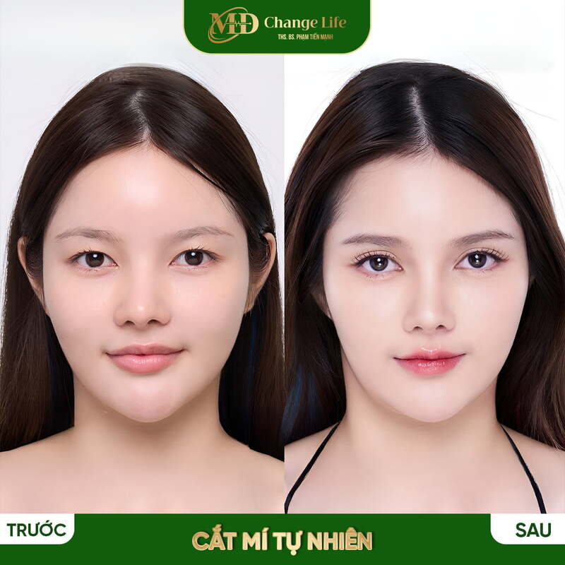 Dịch vụ cắt mí mắt tự nhiên không để lại sẹo tại MD Change Life (Nguồn: MD Change Life )