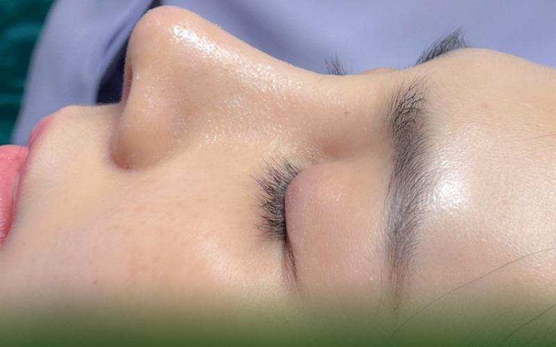 Mũi đẹp nhờ ThS BS Mạnh - bác sĩ nâng mũi giỏi ở Hà Nội (Nguồn: MD Change Life)