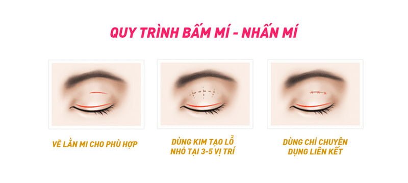 Quy trình thực hiện bấm mí đa điểm (Nguồn: Internet)