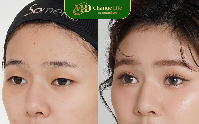 Top 7 địa chỉ bấm mí đa điểm Hà Nội uy tín