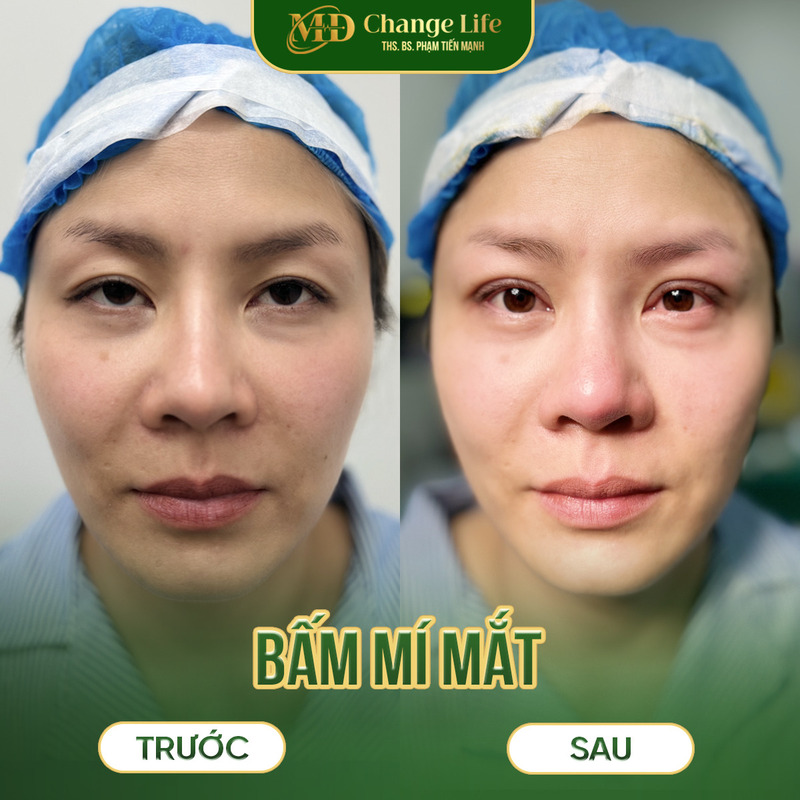 Dịch vụ bấm mí đa điểm tại Thẩm Mỹ MD Change Life Nghệ An (Nguồn: Thẩm Mỹ MD Change Life)