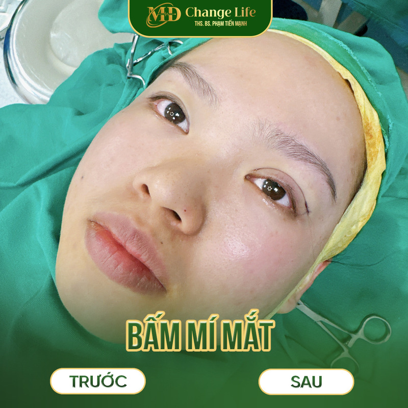 Hiệu quả khi thực hiện bấm mí đa điểm tại Thẩm Mỹ MD Change Life (Nguồn: Thẩm Mỹ MD Change Life)