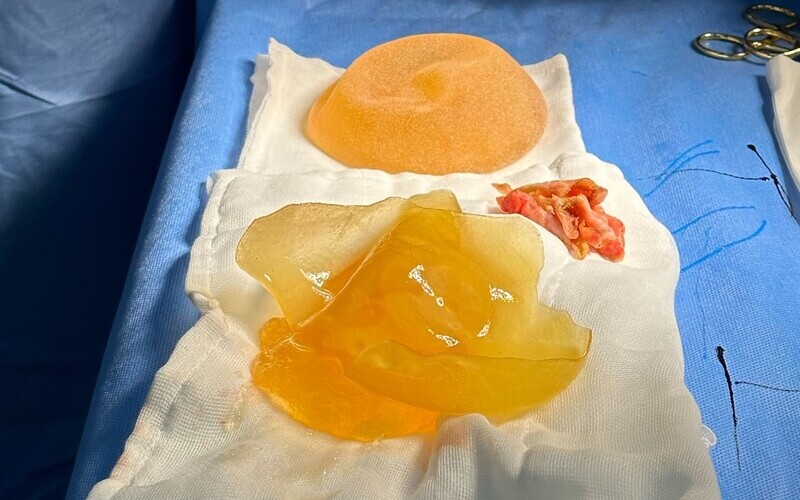 Co thắt bao xơ túi ngực: Nguyên nhân và cách điều trị