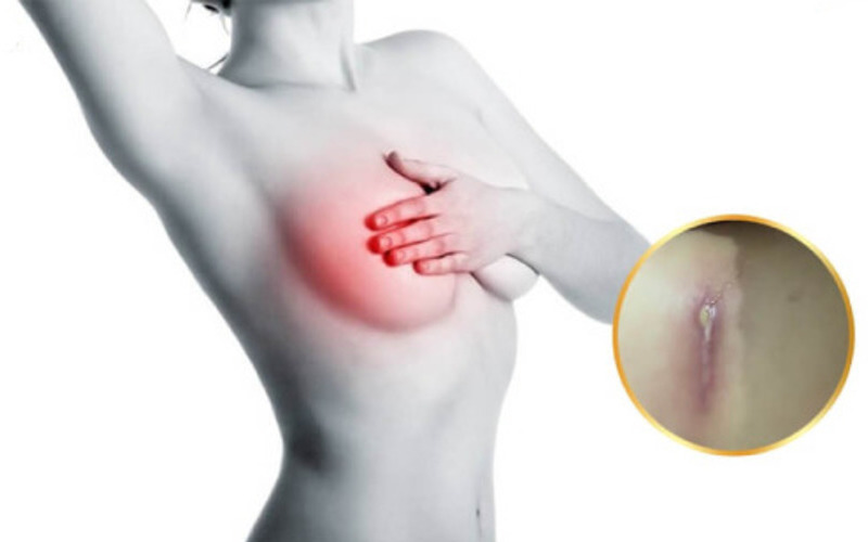 Co thắt bao xơ túi ngực: Nguyên nhân và cách điều trị