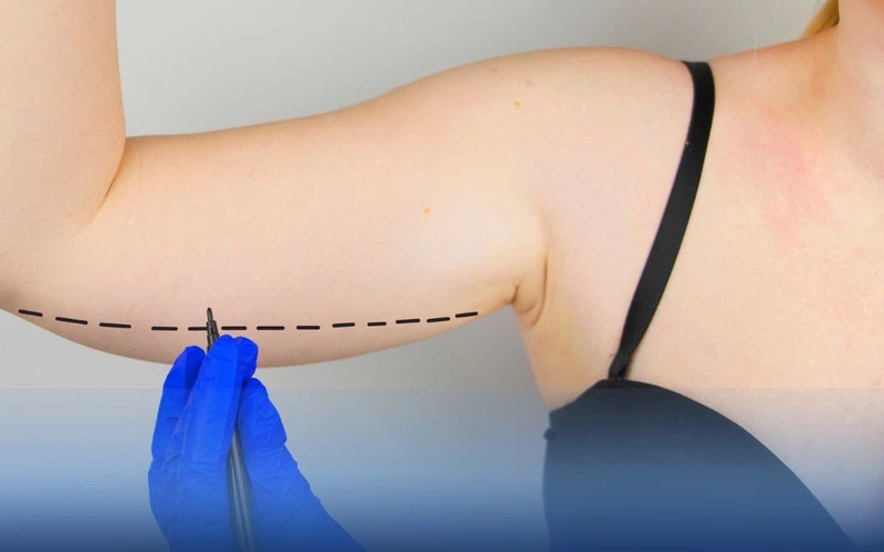 Biến chứng hút mỡ bắp tay: Nguy cơ tiềm ẩn và cách phòng ngừa