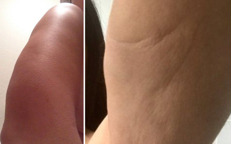 Biến chứng hút mỡ bắp tay: Nguy cơ tiềm ẩn và cách phòng ngừa