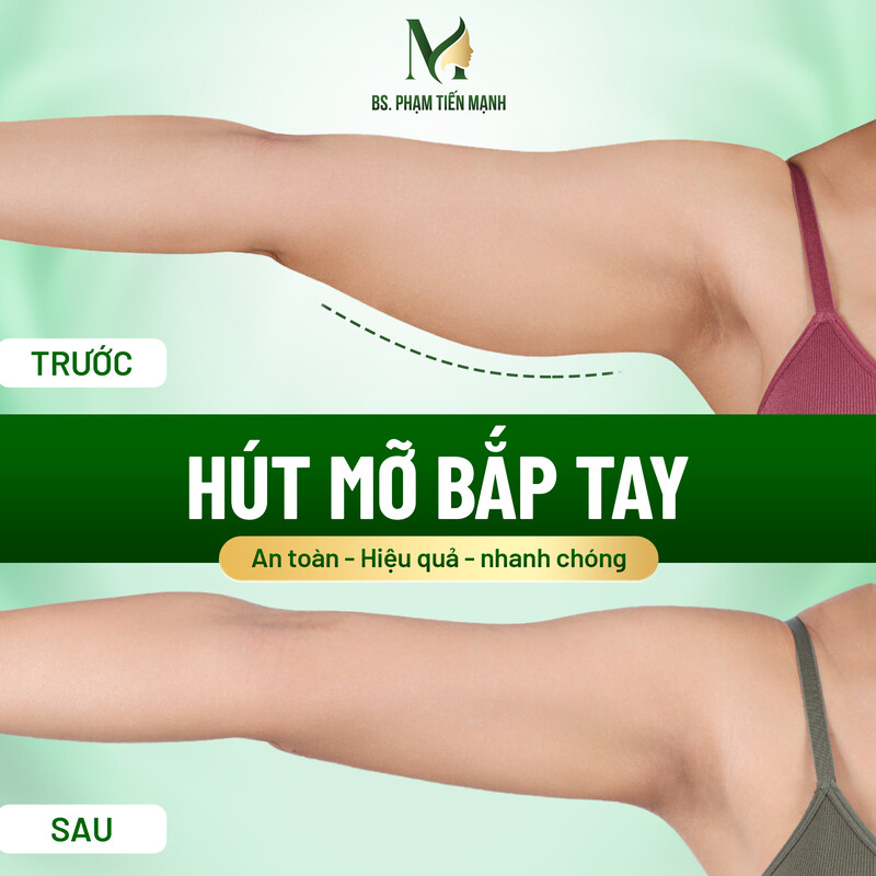 Biến chứng hút mỡ bắp tay: Nguy cơ tiềm ẩn và cách phòng ngừa