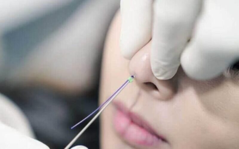 Tìm hiểu phương pháp nâng mũi bằng chỉ và những biến chứng (Nguồn: Internet)
