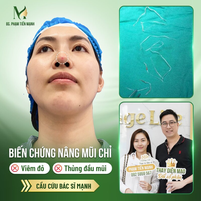 Biến chứng nâng mũi bằng chỉ (Nguồn: MD Change Life)