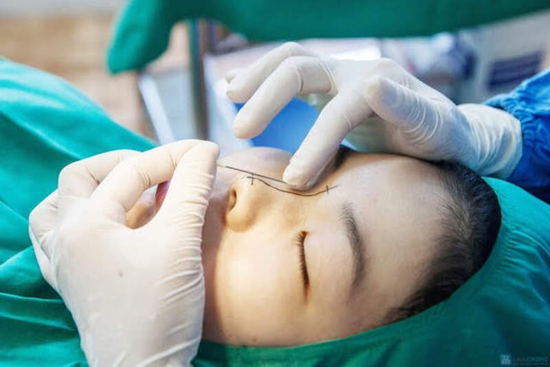 Biến Chứng Nâng Mũi Bằng Chỉ: Những Điều Bạn Cần Biết Trước Khi Quyết Định