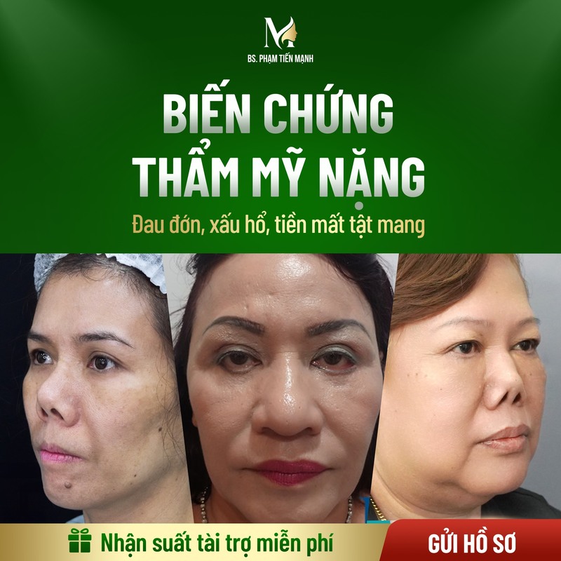 Biến chứng phẫu thuật thẩm mỹ (Nguồn: MD Change Life)