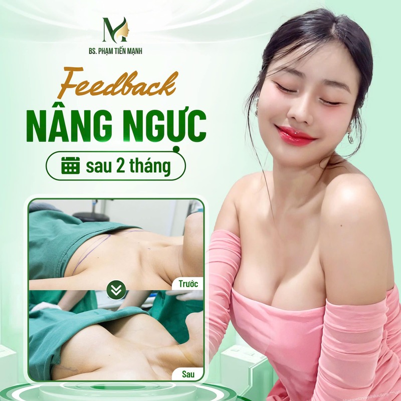 Top Các Loại Túi Ngực Phổ Biến Nhất Hiện Nay