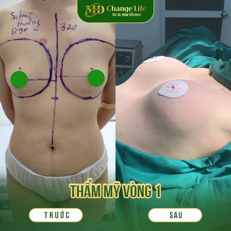 Cách chọn túi nâng ngực phù hợp