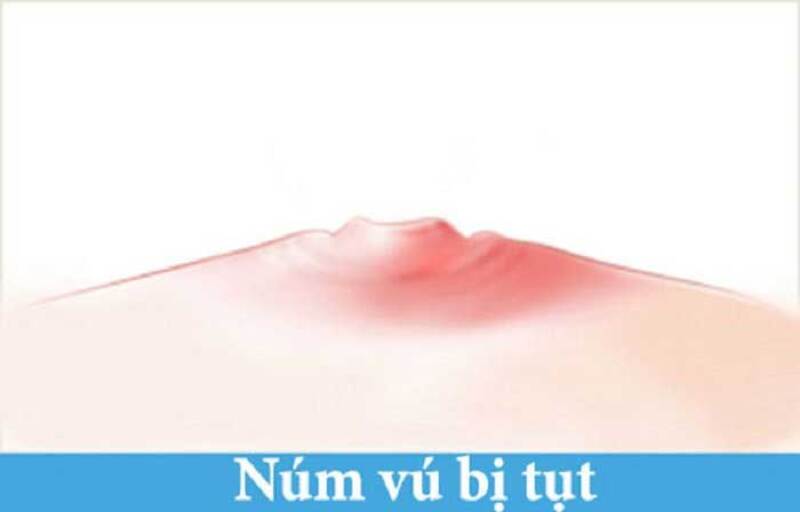 3 cách khắc phục núm vú bị tụt vào trong
