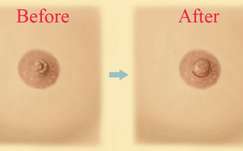 3 cách khắc phục núm vú bị tụt vào trong