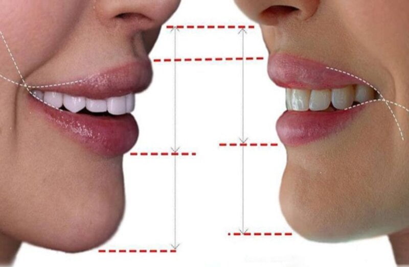 Căng chỉ tạo khoé môi - Là cách tạo khoé môi giúp bạn có một nụ cười tự nhiên (Nguồn: Internet)