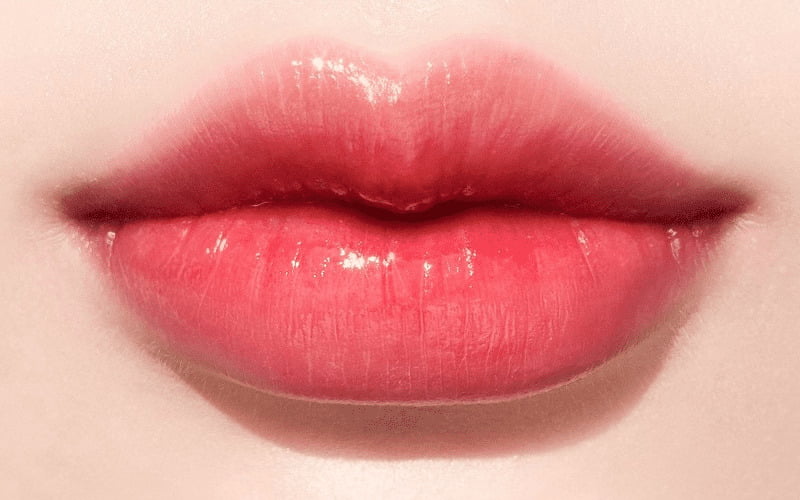 Cách tiêm tạo khoé môi xinh