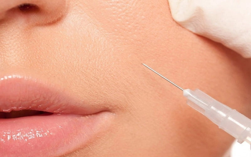 Cách tiêm tạo khoé môi xinh