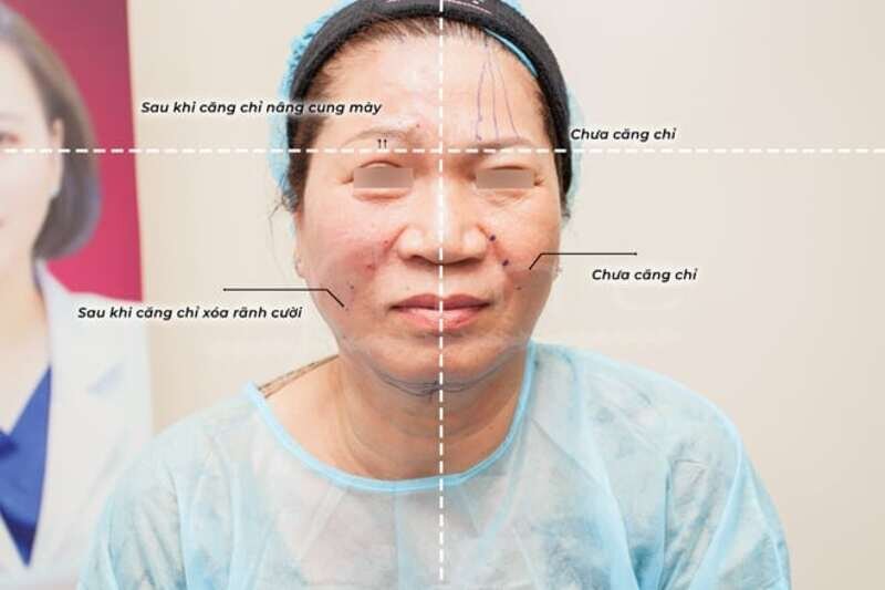 Đánh bay nếp nhăn bằng cách căng chỉ trẻ hoá gương mặt (Nguồn: Internet)