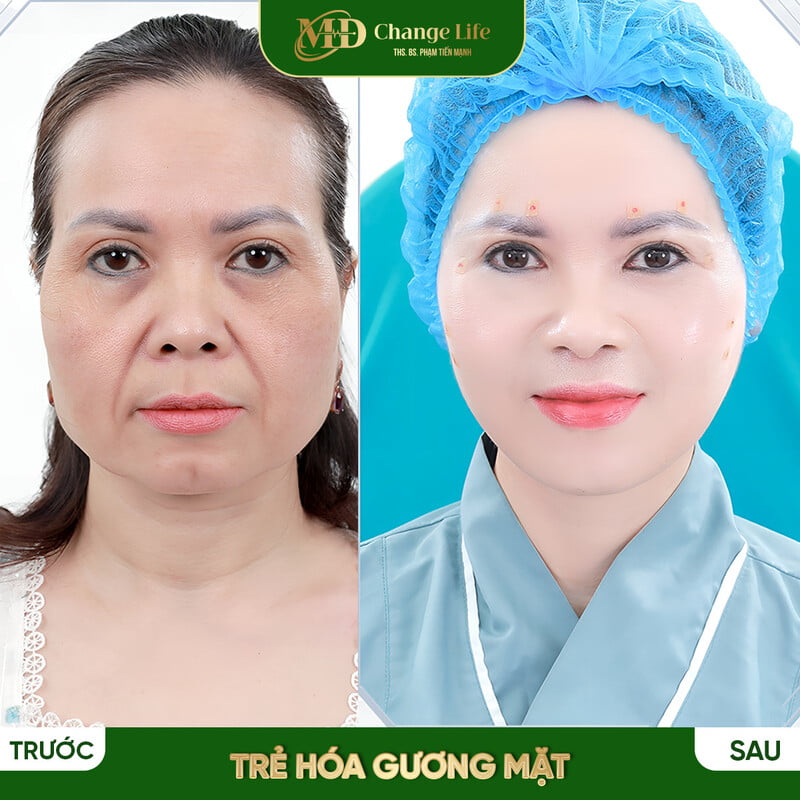 Căng chỉ trẻ hoá gương mặt tại MD Change Life là lựa chọn đúng đắn (Nguồn: Internet)