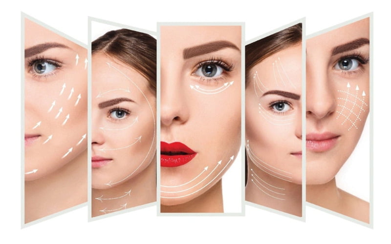 Căng chỉ trẻ hóa mắt (Nguồn: Internet)