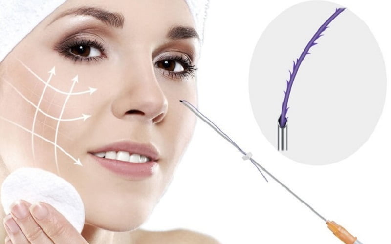 Thực hiện căng chỉ (Nguồn: Internet)