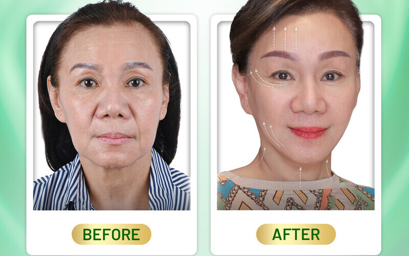 Thẩm Mỹ MD Change Life - Căng chỉ trẻ hóa mắt Hà Nội uy tín (Nguồn: MD Change Life)