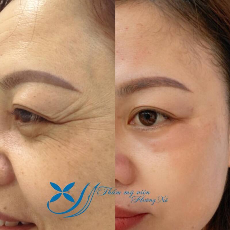 Căng chỉ trẻ hóa mắt tại Thẩm mỹ viện Hường Xô (Nguồn: Thẩm mỹ viện Hường Xô)