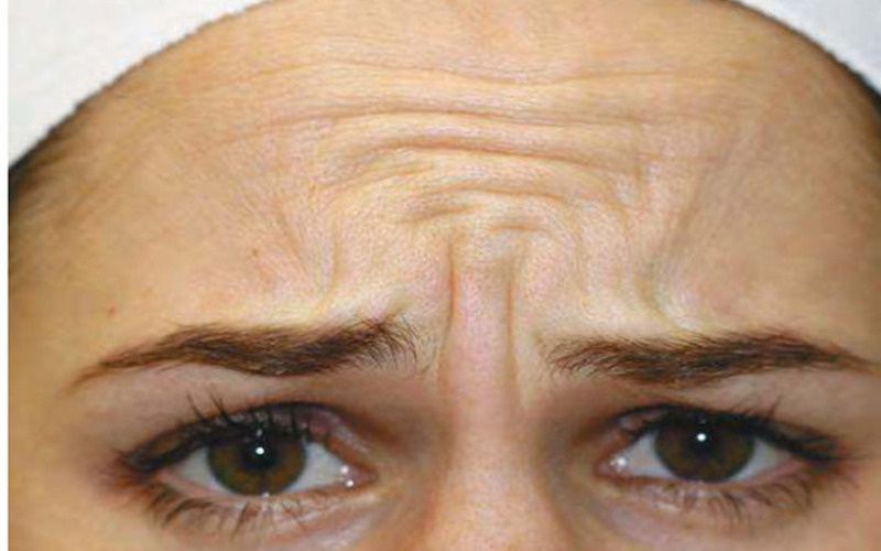 Nếp nhăn cau mày (Nguồn: Internet)