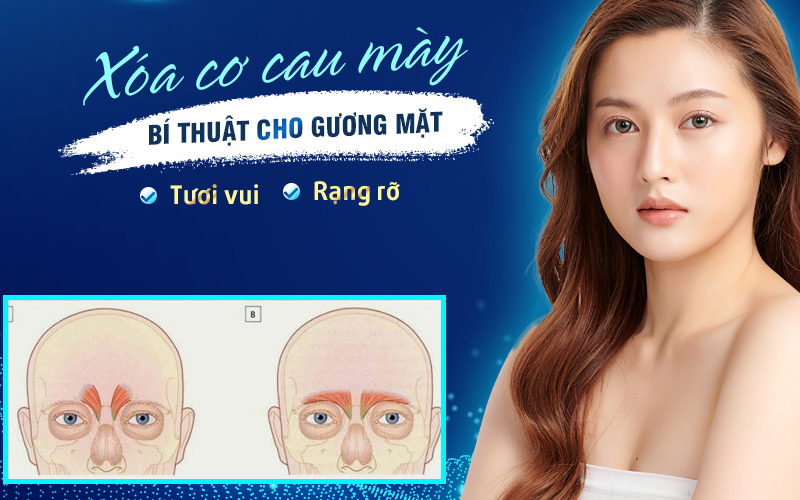 Cắt cơ cau mày (Nguồn: Internet)