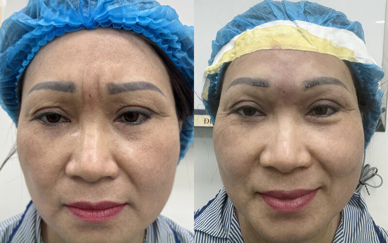 MD Change Life tại Hà Nội là địa chỉ uy tín và an toàn cho dịch vụ cắt cơ cau mày Hà Nội (Nguồn: MD Change Life)