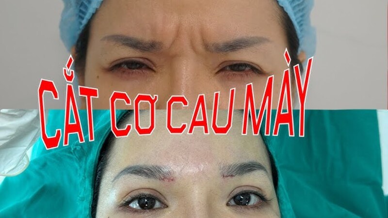 Bệnh viện Thẩm mỹ Kangnam - Dịch vụ cắt cơ cau mày Hà Nội (Nguồn: Internet)