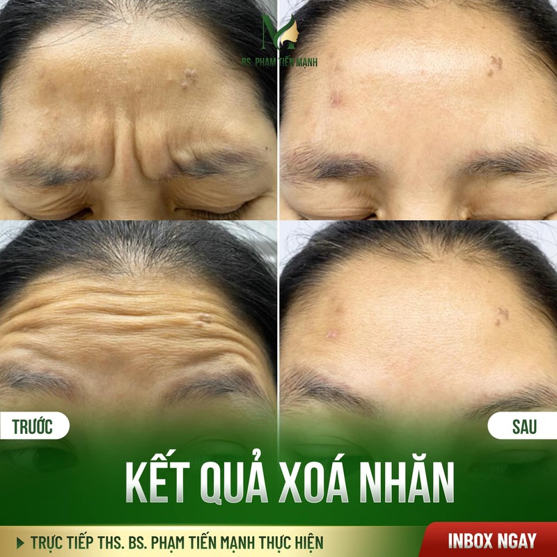 Dịch vụ cắt cơ cau mày tại Thẩm Mỹ MD Change Life (Nguồn: Thẩm Mỹ MD Change Life)