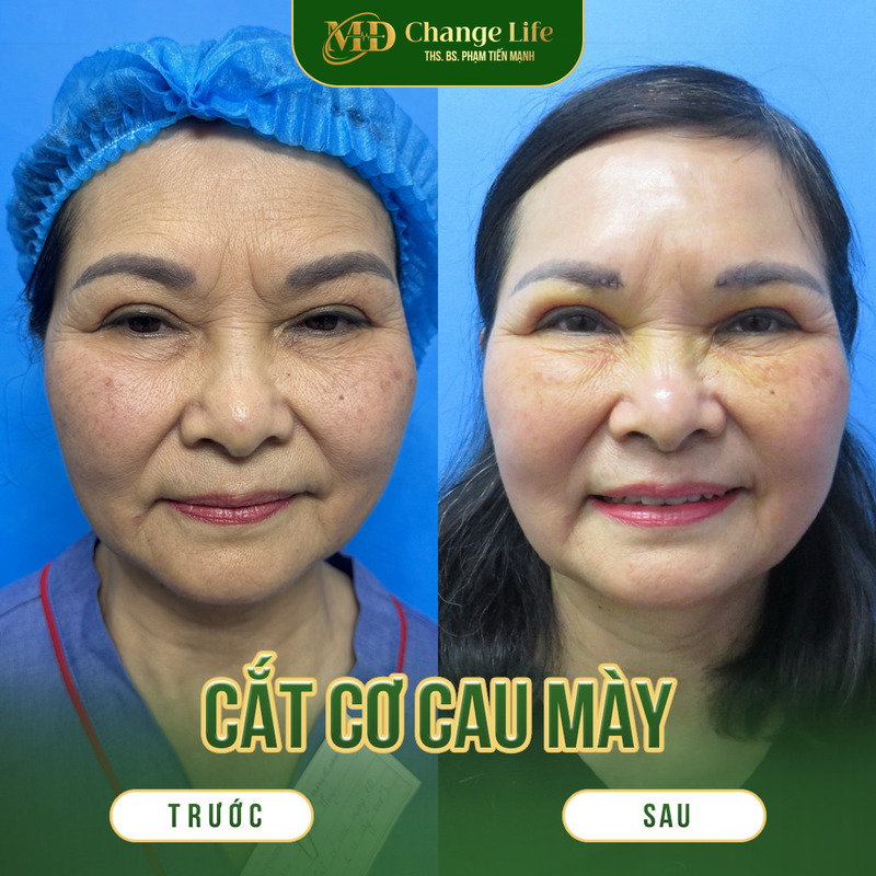 Hiệu quả cắt cơ cau mày tại Thẩm Mỹ MD Change Life (Nguồn: Thẩm Mỹ MD Change Life)