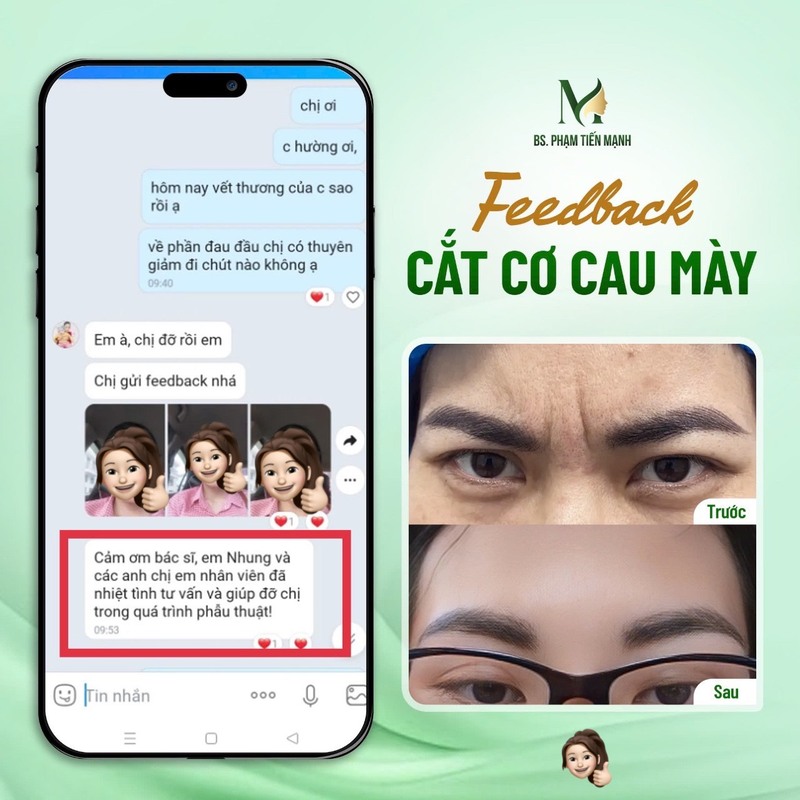 Cắt cơ nhíu mày – Xóa tan nếp nhăn, trẻ hóa gương mặt