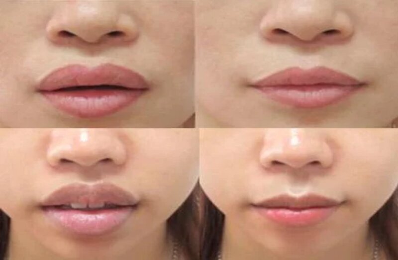 Cắt khoé miệng cười là như thế nào? (Nguồn: Internet)