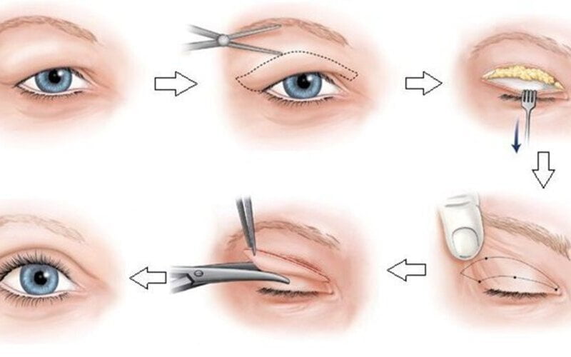 Cắt mí mắt (trên hoặc dưới) là giải pháp tối ưu giúp bạn loại bỏ hoàn toàn da chùng bọng mỡ mí mắt (Nguồn: Internet)