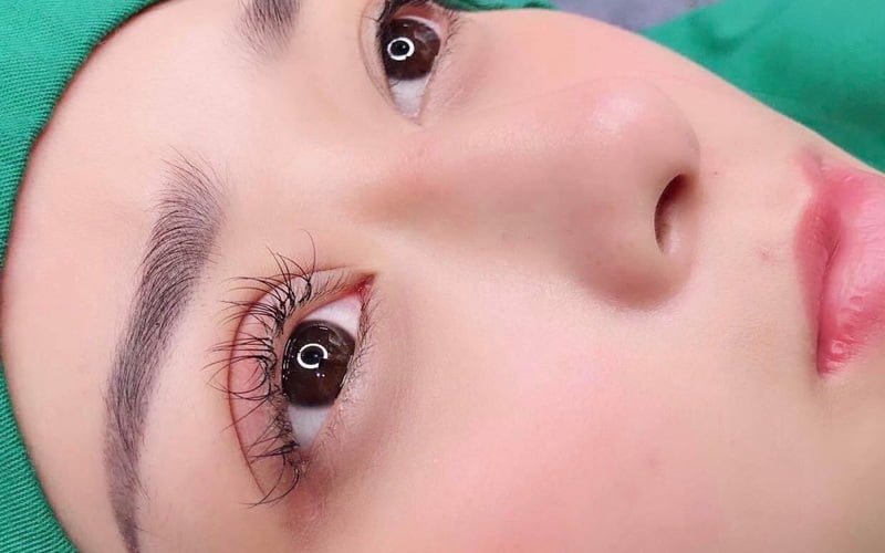 Kỹ thuật cắt mí có phần nổi trội hơn với hiệu quả vĩnh viễn (Nguồn: Internet)