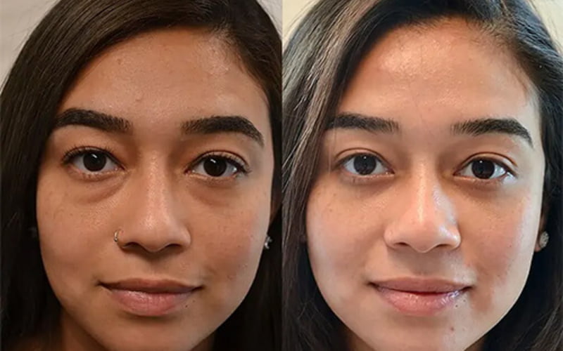 Cắt mí bao lâu thì đẹp? Hết sưng, lành hẳn trong bao lâu?