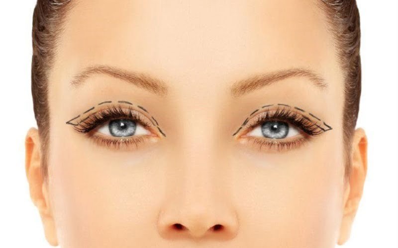 Cắt mí bao lâu thì đẹp? Hết sưng, lành hẳn trong bao lâu?