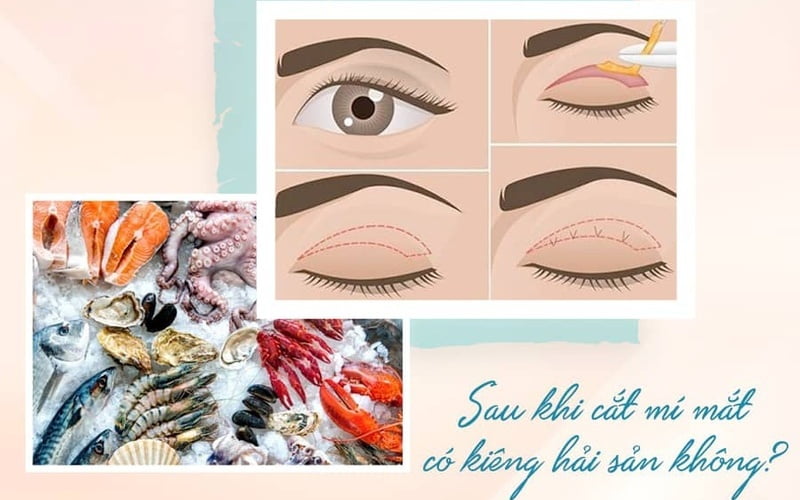 Cắt mí bao lâu thì đẹp? Hết sưng, lành hẳn trong bao lâu?