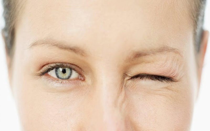 Cắt mí bao lâu thì đẹp? Hết sưng, lành hẳn trong bao lâu?