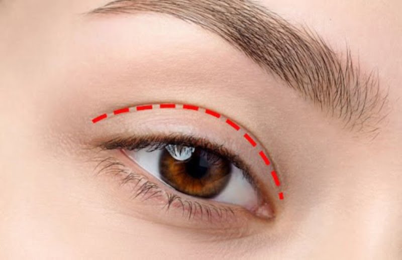Cắt mí mắt là gì? (Nguồn: Internet)