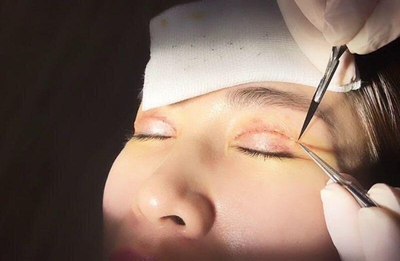 Cắt mí có đau không? Phụ thuộc chủ yếu vào cơ địa mỗi người (Nguồn: Internet)