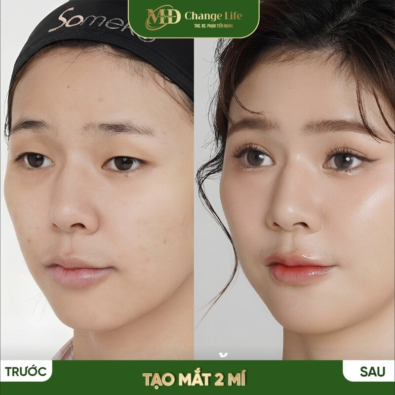 Đến với Thẩm mỹ MD Change Life bạn sẽ lấy lại đôi mắt tròn 2 mí (Nguồn: Internet)