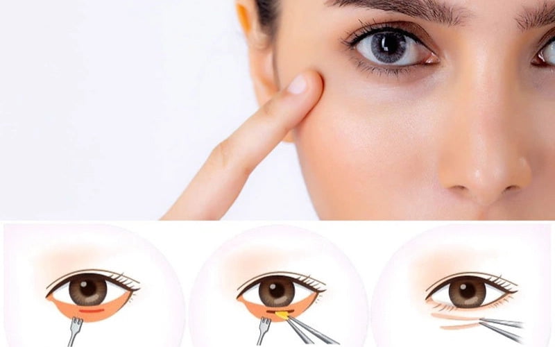 Cắt mí dưới (Nguồn: Internet)