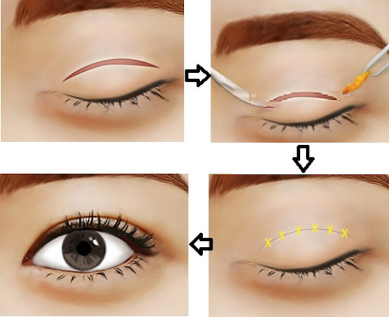 Cắt mí dưới tại Nghệ An có lợi ích gì? (Nguồn: Internet)