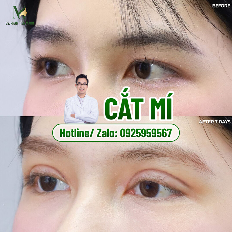 5 địa chỉ cắt mí Hà Nội đẹp tự nhiên, uy tín nhất